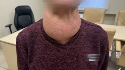 Огромный зоб едва не задушил жительницу Альметьевска 02/02/2026 &ndash; Новости