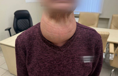 Жительницу Татарстана избавили от щитовидной железы размером с голову